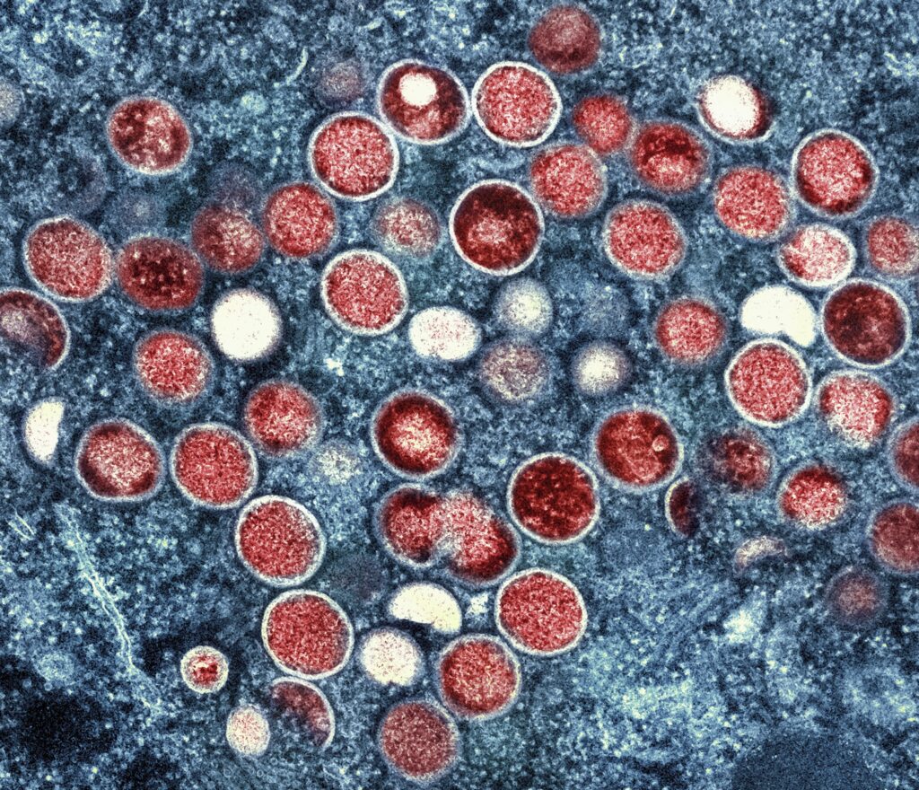 Monkeypox: Facts on symptoms, transmission